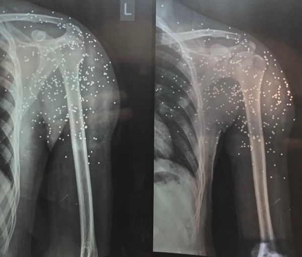 Sixteen-year-old protestor in Iran with multiple pellets in the left shoulder and few in the chest has lost the ability to move his arm due to permanent nerve injury.