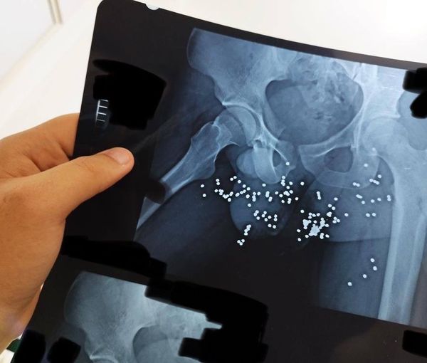 An x-ray image showing the genitals of a protester targeted by security forces (March 2023)