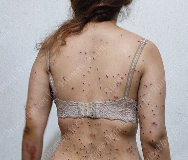 A woman shot in Tehran in October with shotgun pellets