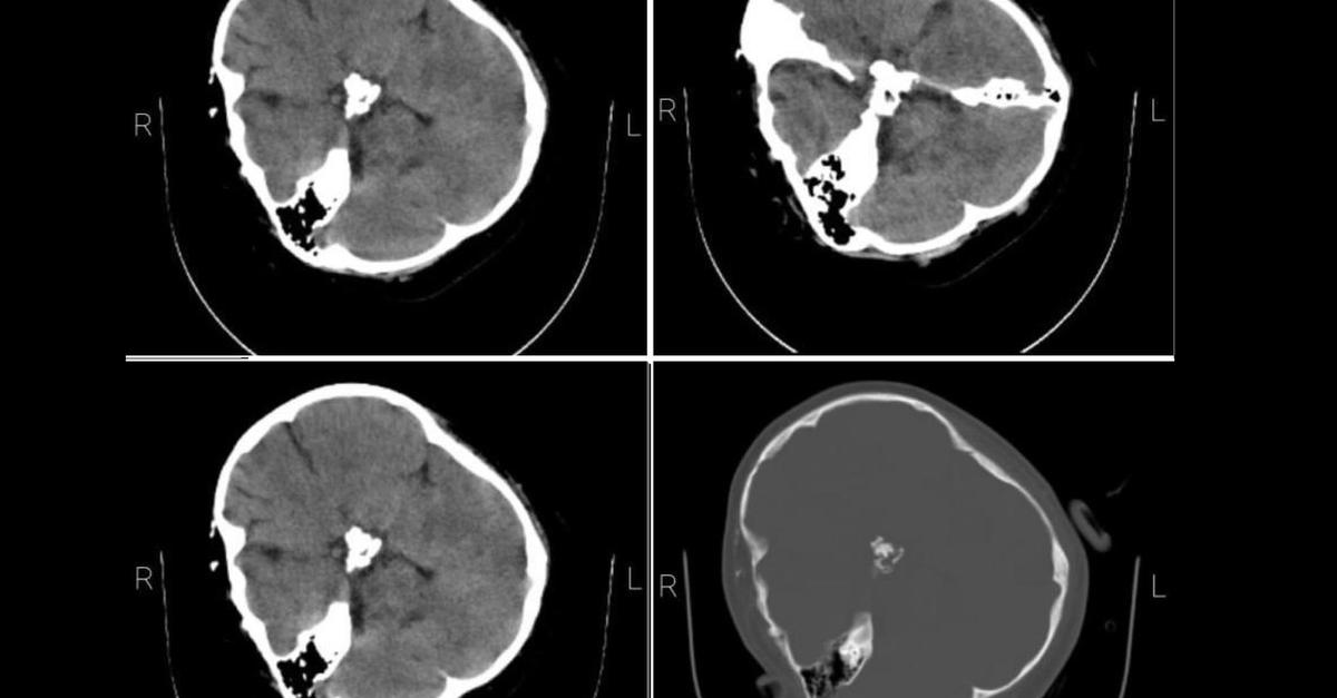 Mahsa Amini s CT Scan Shows Skull Fractures Caused By Severe Blows mahsa-amini-s-ct-scan-shows-skull-fractures-caused-by-severe-blows